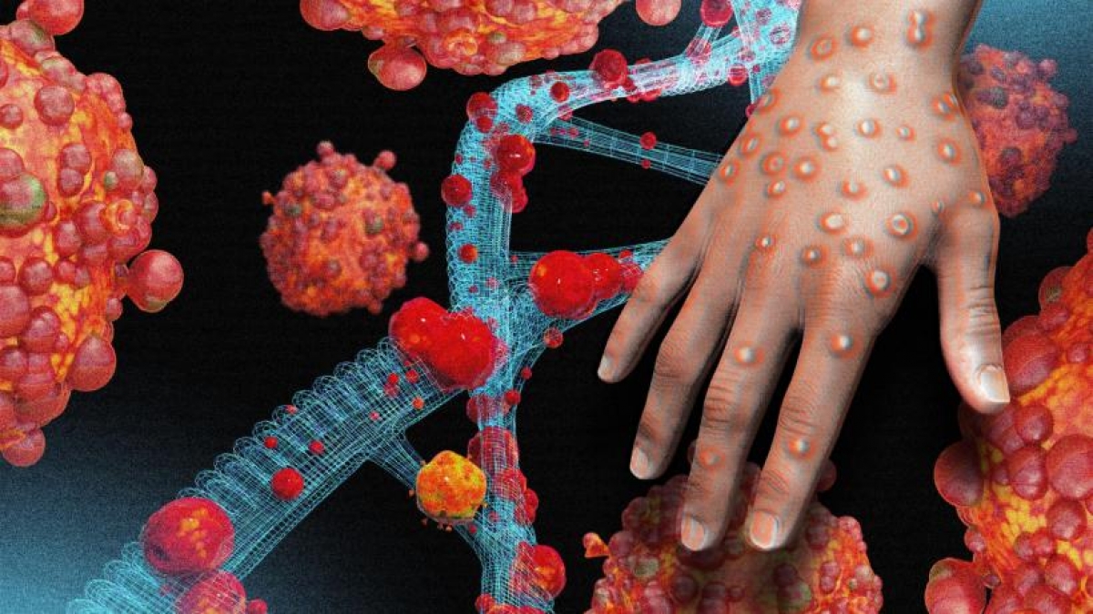 Mpox declarată urgență globală de către OMS / Ce știm până acum