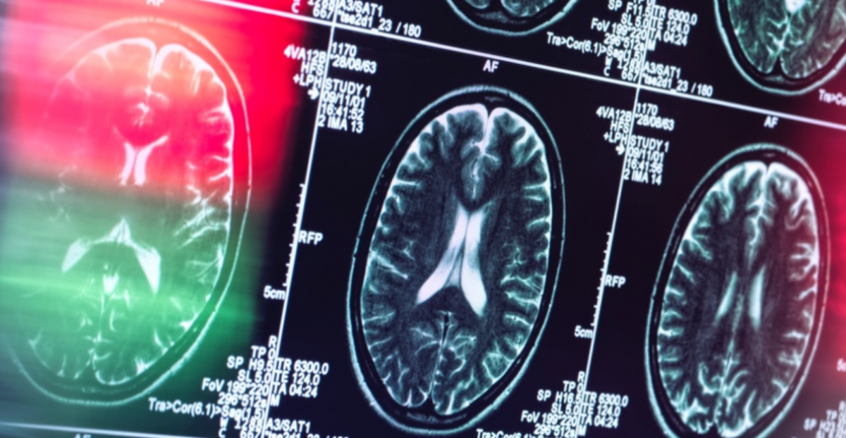 Alzheimer ar putea să nu fie de fapt o boală a creierului: o nouă torie venită pe baza ultimilor 30 de ani de cercetare