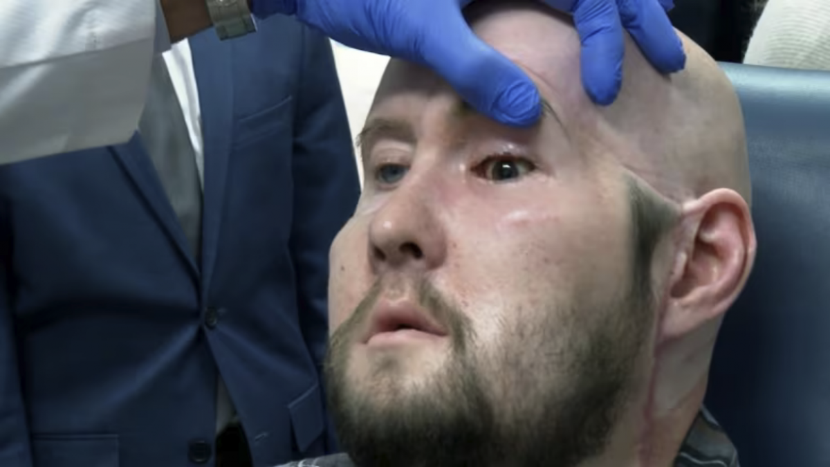 Premieră în chirurgia reconstrucției faciale: primul transplant total de ochi și parțial de față realizat cu succes
