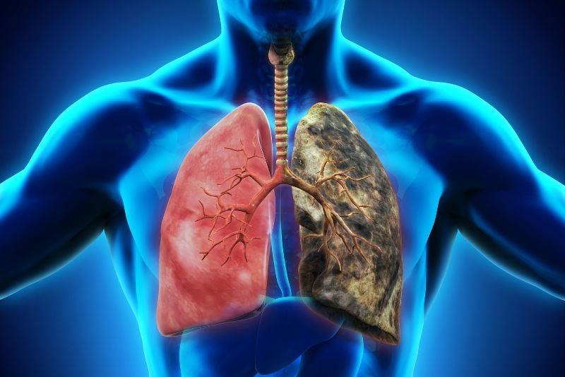 Un nou studiu sugerează că 1,2 milioane de vieți ar putea fi salvate de cancer pulmonar prin măsuri preventive adecvate.