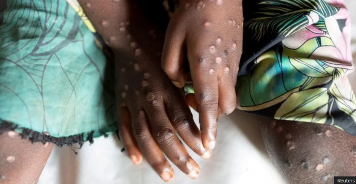 Africa înregistrează 866 de decese cauzate de mpox în acest an, conform Africa CDC