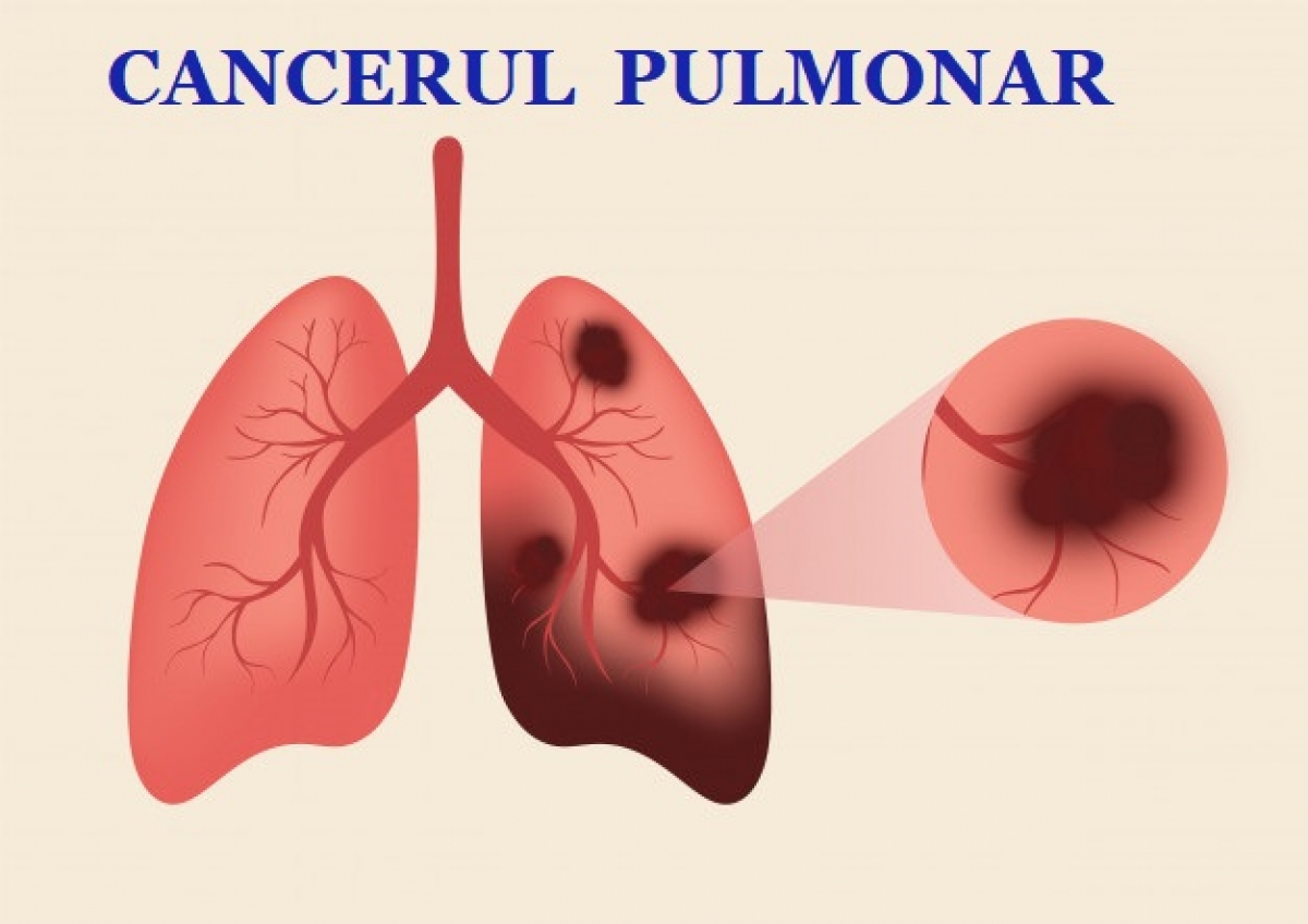Cercetătorii din China dezvoltă un senzor care detectează cancerul pulmonar cu o precizie remarcabilă