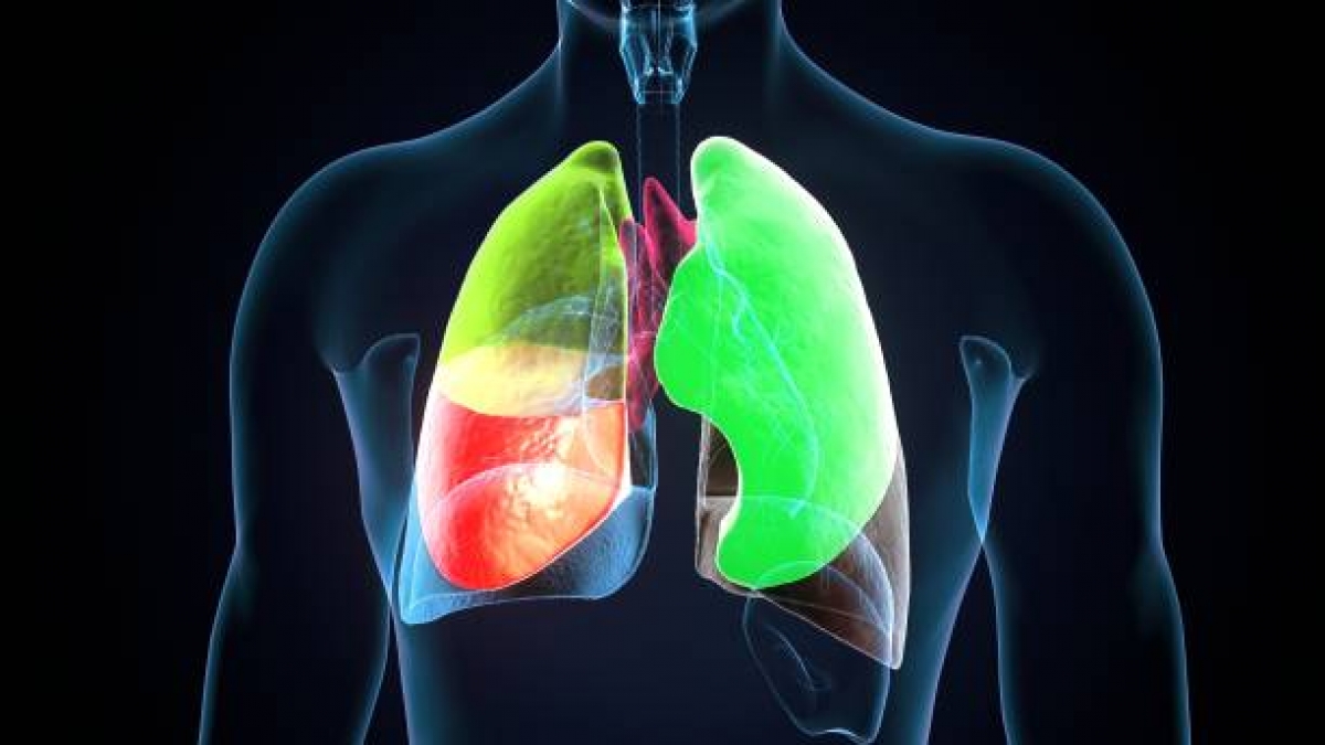 O genă rară, dar mai frecventă decât se credea, crește riscul de diagnosticare cu sindromul 'plămânului perforat'