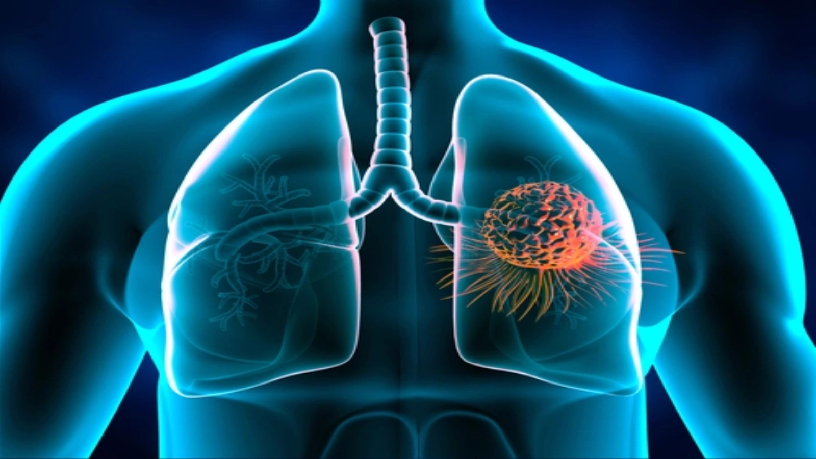 Studiu: Intervenţia chirurgicală rămâne o soluţie pentru bolnavii de cancer pulmonar în vârstă de peste 80 de ani