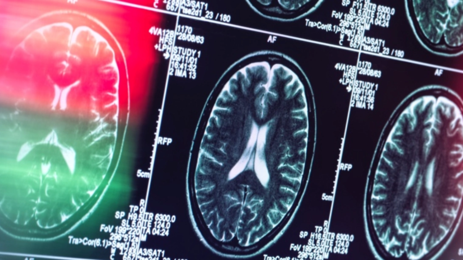 Institutul de Psihiatrie 'Socola' introduce un tratament unic în România pentru Alzheimer
