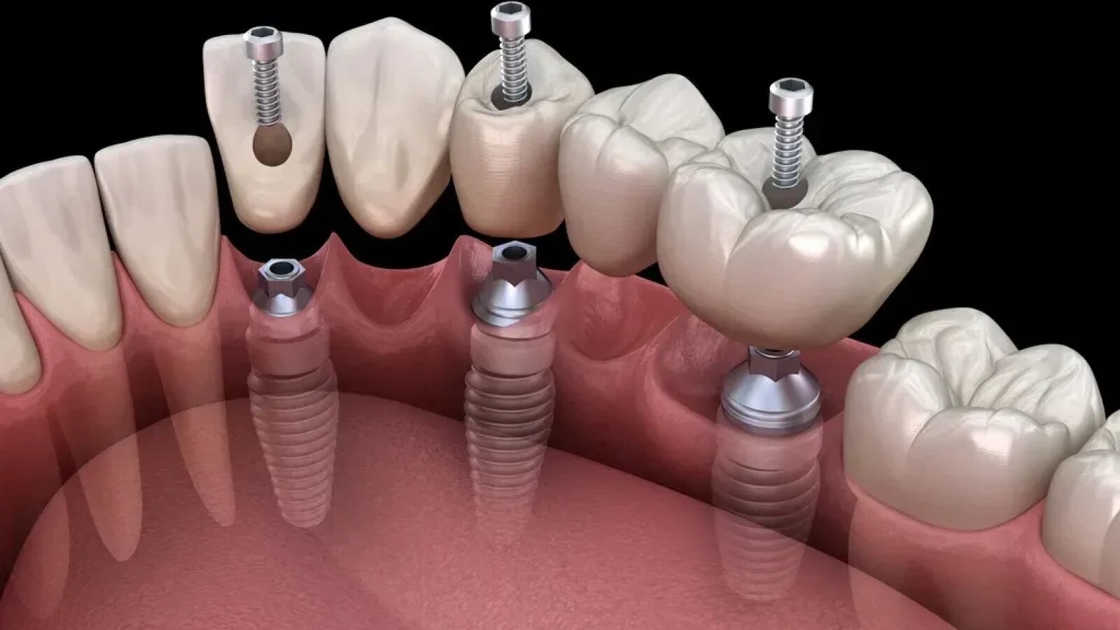 Cât rezistă un implant dentar și ce poți face pentru a-i prelungi durata de viață